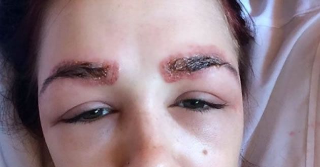 Mujer se quema con tratamiento para cejas